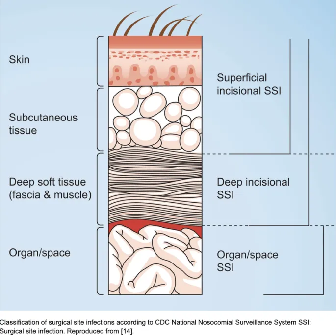 CDC Surgical Site Infection Classification