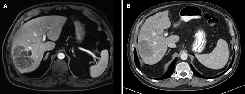 MRI and CT of liver metastasis