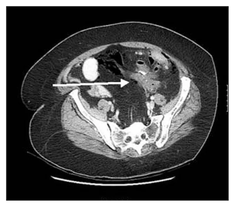 CT scan: Extraluminal air and fluid, anastomotic leak