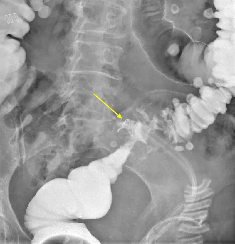 Anastomotic leak on barium enema