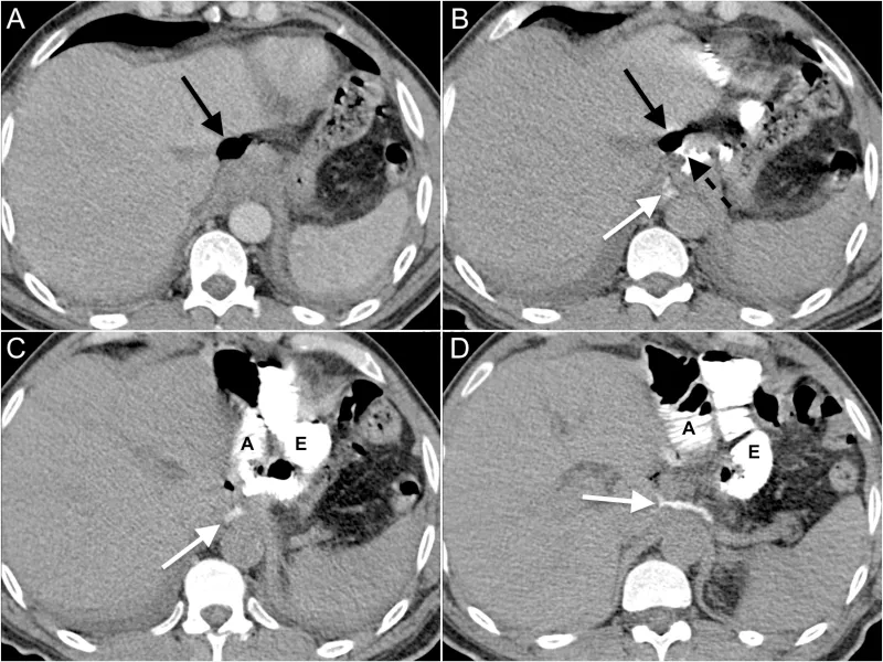 CT: Anastomotic leak with extraluminal contrast & abscess