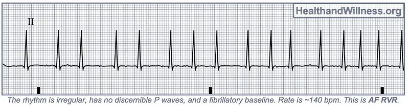 EKG: Atrial Fibrillation with Rapid Ventricular Response