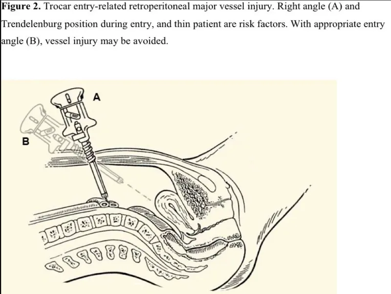 Trocar injury to major vessels