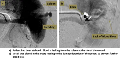 Embolization of splenic artery bleeding with coils