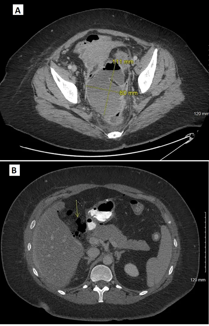 CT scan: Postoperative intra-abdominal fluid collection