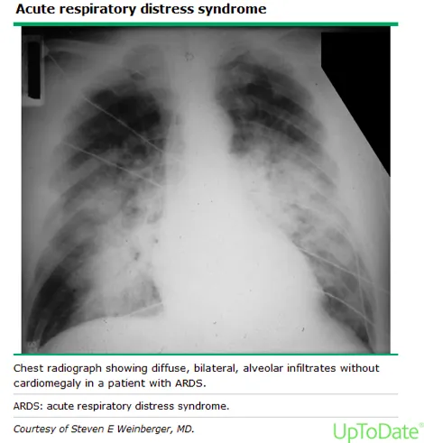 Chest X-ray: Bilateral diffuse opacities in ARDS