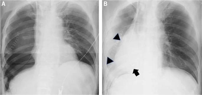 Postoperative pneumonia with lobar consolidation on CXR
