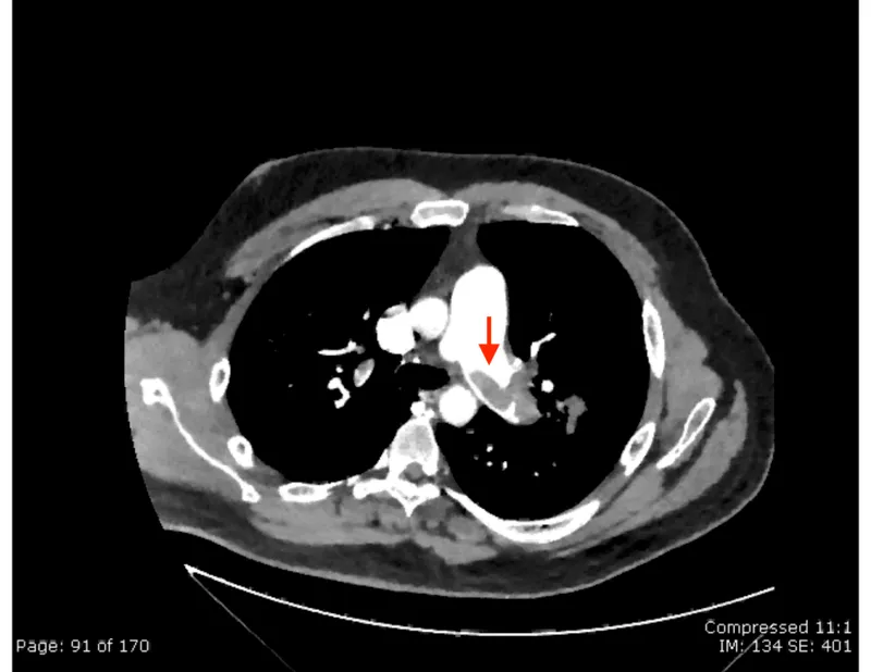 CT angiogram of saddle pulmonary embolus