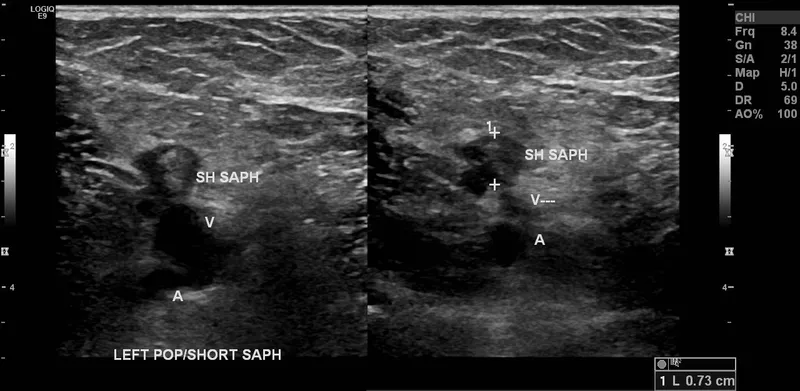 Ultrasound of non-compressible popliteal vein (DVT)