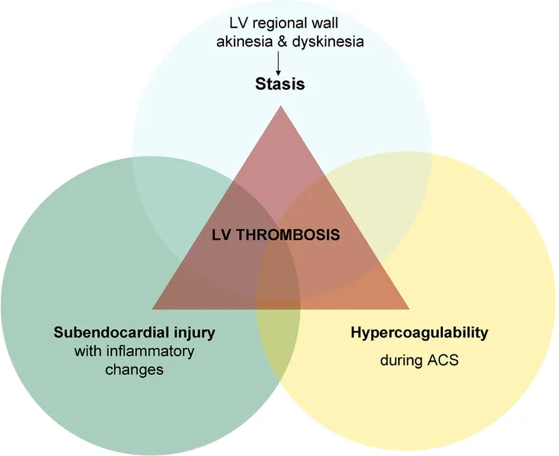 Virchow's Triad and LV Thrombosis
