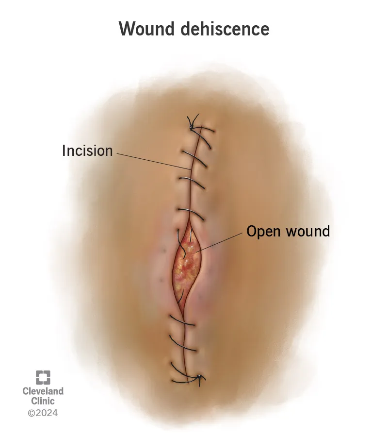 Wound Dehiscence