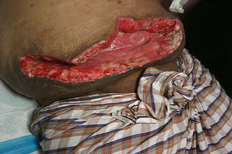 Abdominal wound dehiscence with exposed underlying tissue
