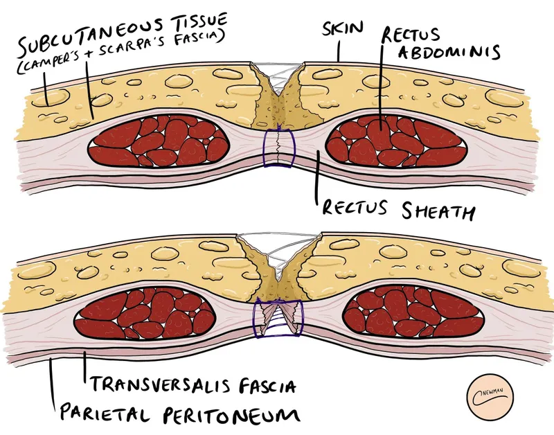 Abdominal wall layers and wound dehiscence