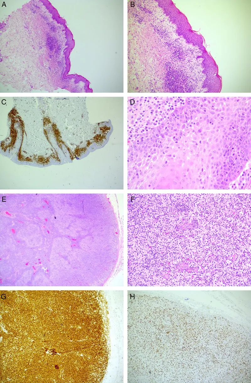 GVHD skin rash and PTLD lymph node biopsy