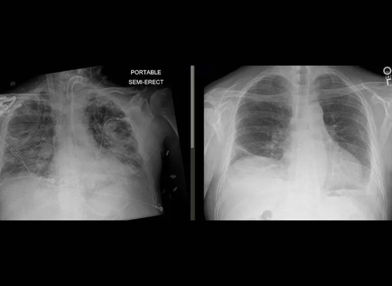 Chest X-ray: Pre- and post-lung transplant