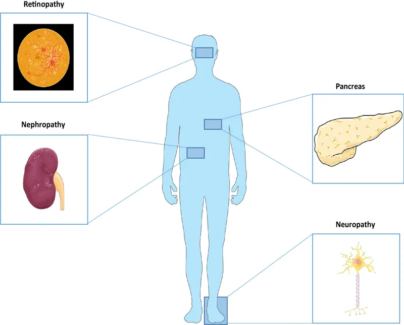 Diabetic complications: retinopathy, nephropathy, neuropathy
