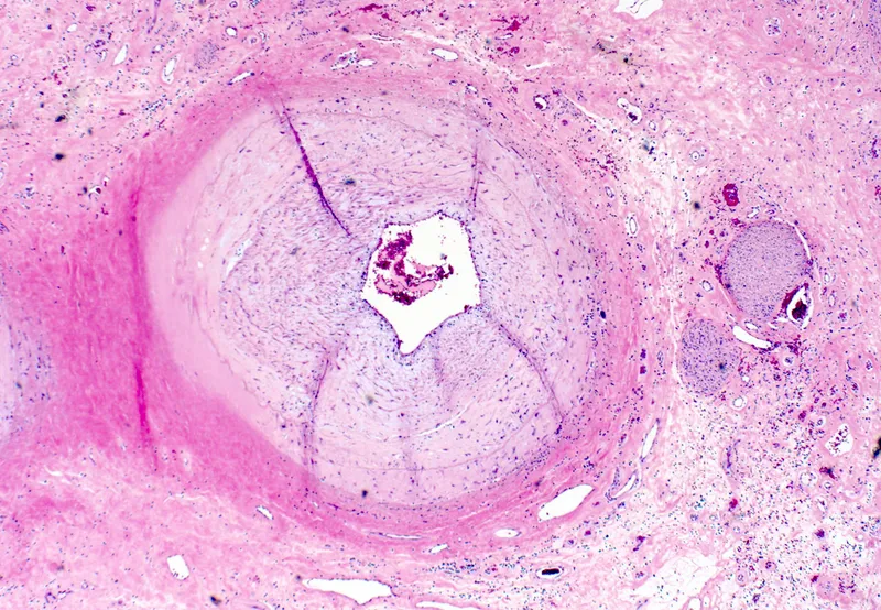 Cardiac Allograft Vasculopathy Histopathology