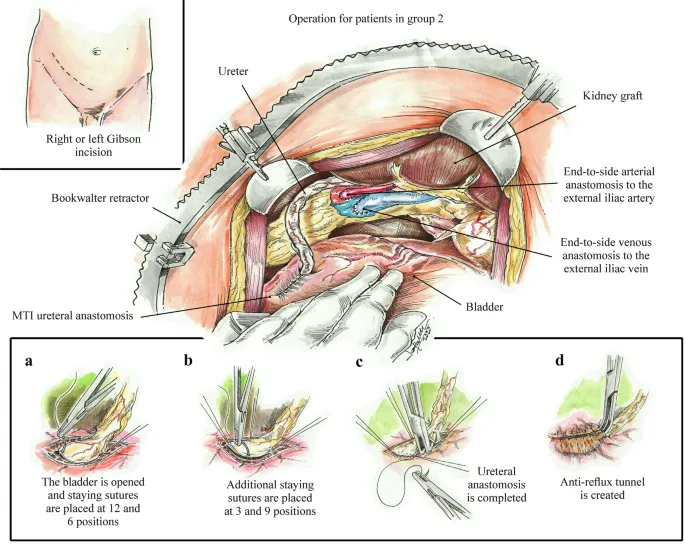 Kidney Transplant: Surgical Anatomy & Ureteral Anastomosis