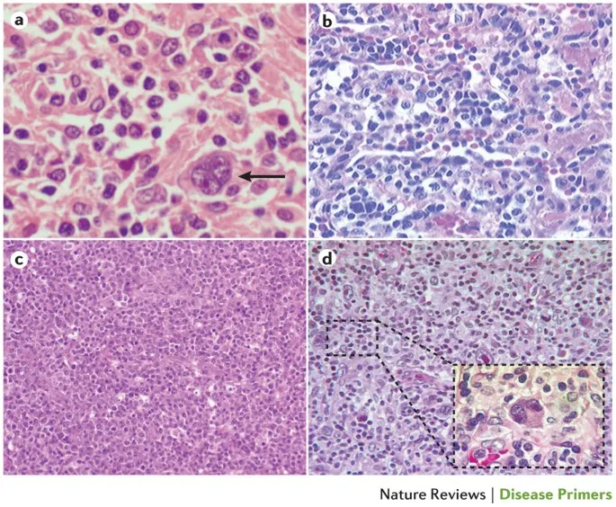 Histology of Post-transplant Lymphoproliferative Disorder