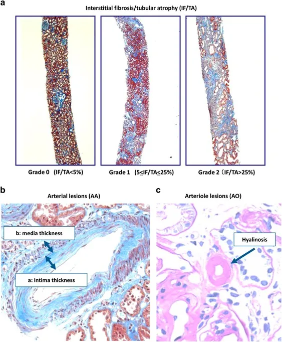 Histopathology of Chronic Kidney Transplant Rejection