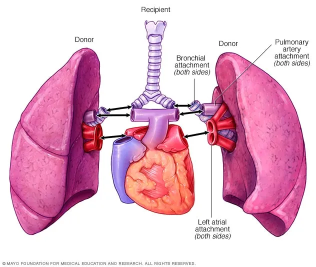 Lung Transplant Anastomoses