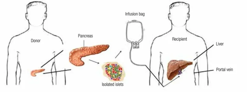 Islet cell isolation and infusion