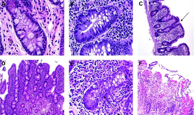 Histology of acute small bowel transplant rejection