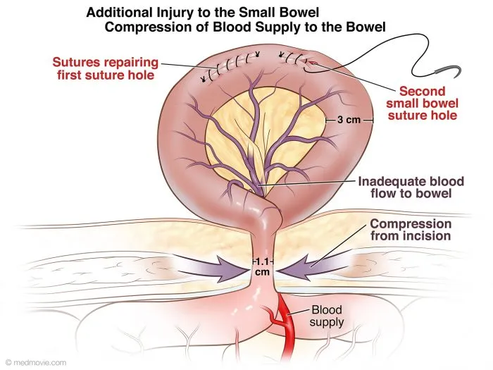 Small bowel injury repair