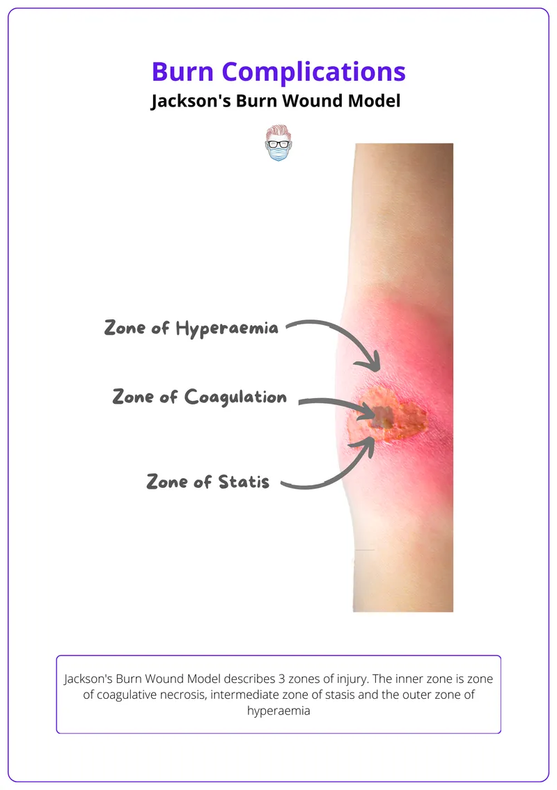 Jackson's Burn Wound Model