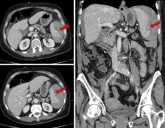 CT: Splenic Laceration with Active Extravasation