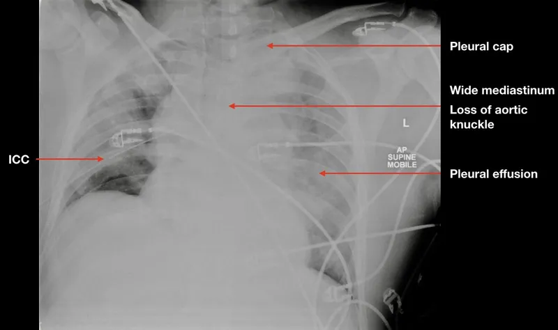 CXR: Widened mediastinum, pleural effusion, ICC