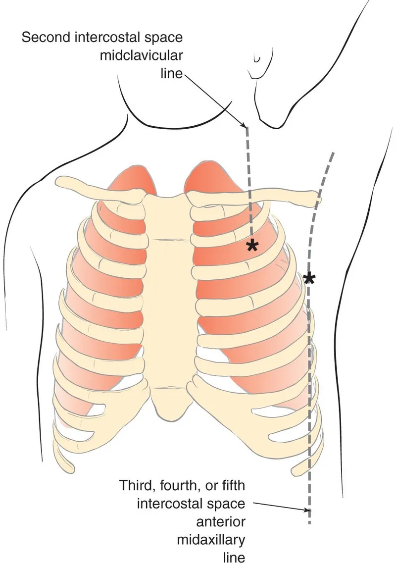 Chest tube and needle decompression anatomical landmarks
