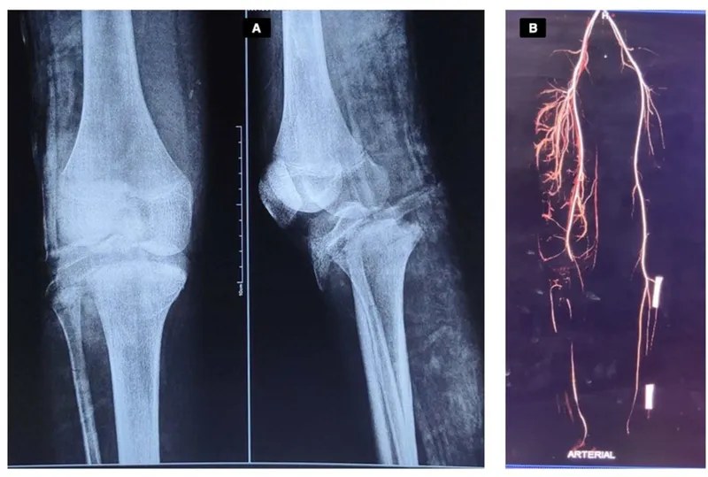 Knee dislocation with popliteal artery transection