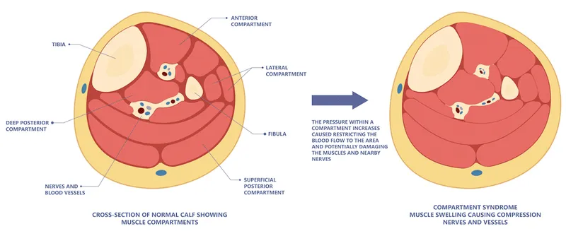 Lower Leg Compartment Syndrome Pathophysiology