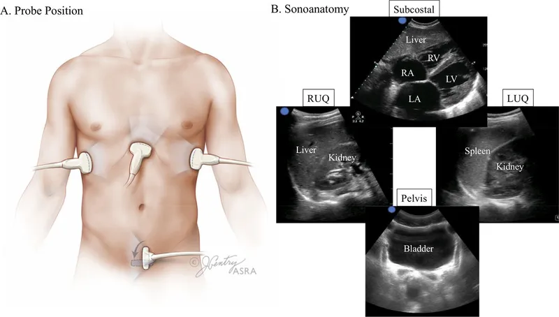 FAST exam probe positions and corresponding sonoanatomy
