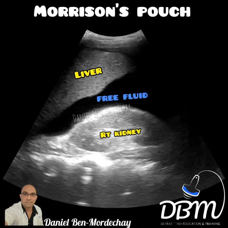 FAST exam: Free fluid in Morison's pouch