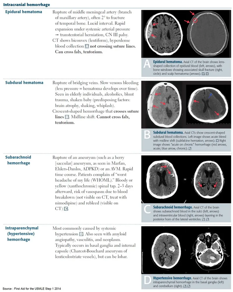 CT Comparison of Intracranial Hemorrhages
