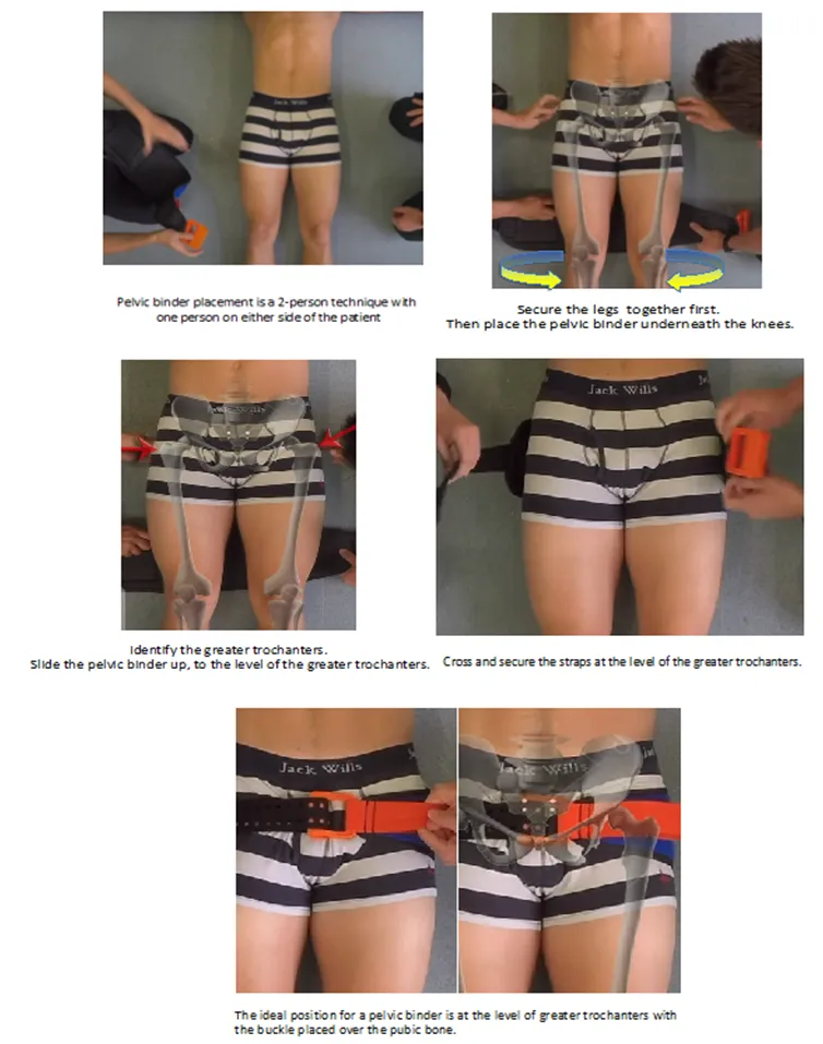 Pelvic binder application steps with anatomical overlay