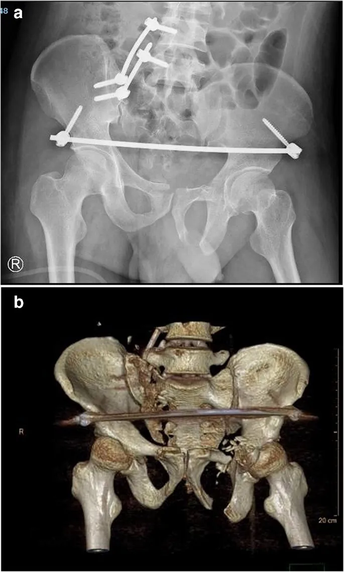 Pelvic fracture fixation: X-ray and 3D CT reconstruction