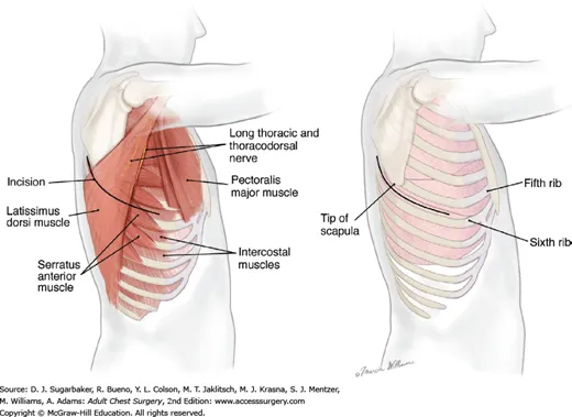 Anterolateral thoracotomy incision landmarks