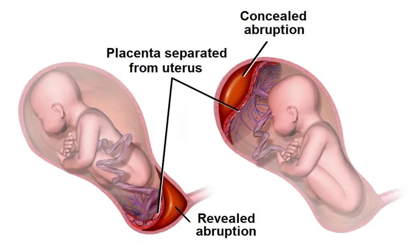 Placental Abruption: Revealed vs. Concealed Hemorrhage