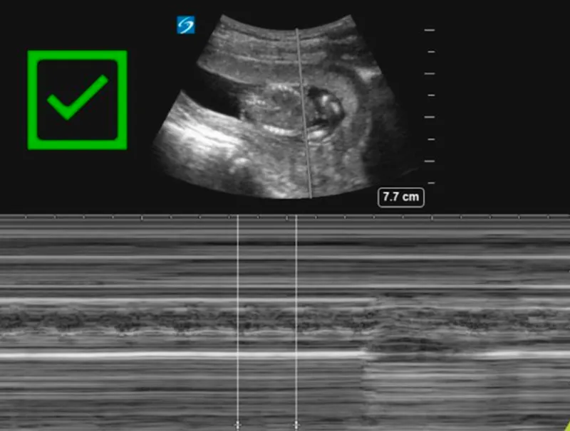 Fetal ultrasound with M-mode showing heart activity