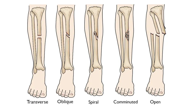 Types of Tibia and Fibula Fractures