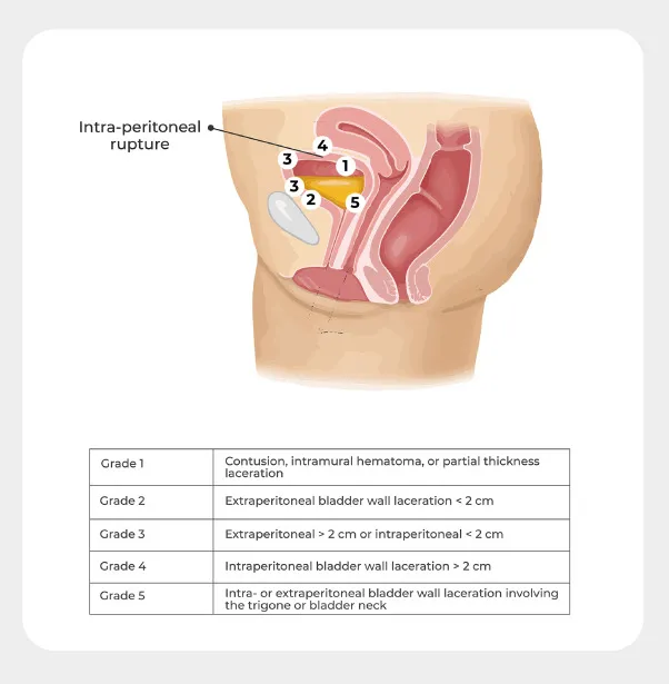 Bladder Trauma Grading