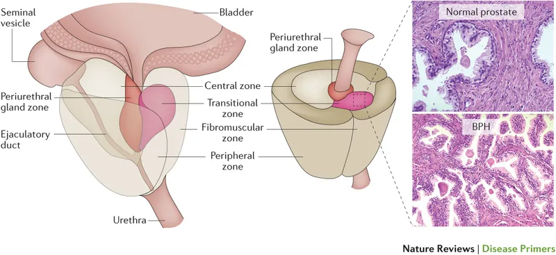 Prostate anatomy and BPH histology