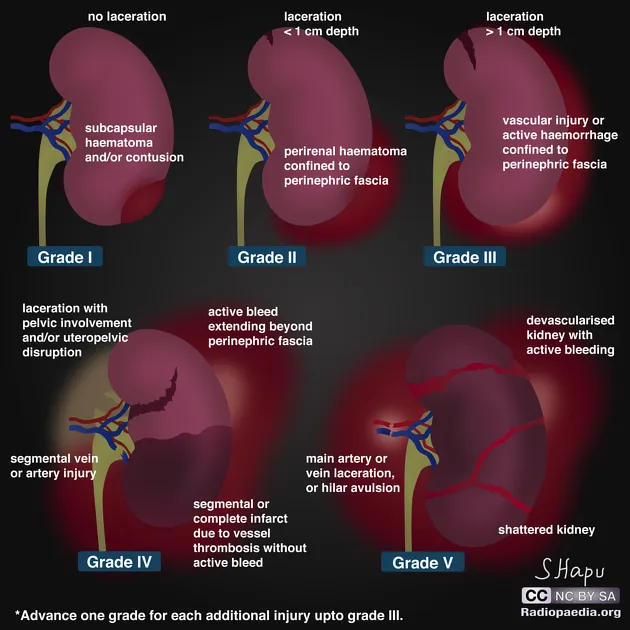 AAST Renal Injury Grading