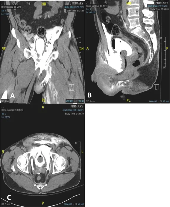 CT showing bladder rupture with contrast extravasation