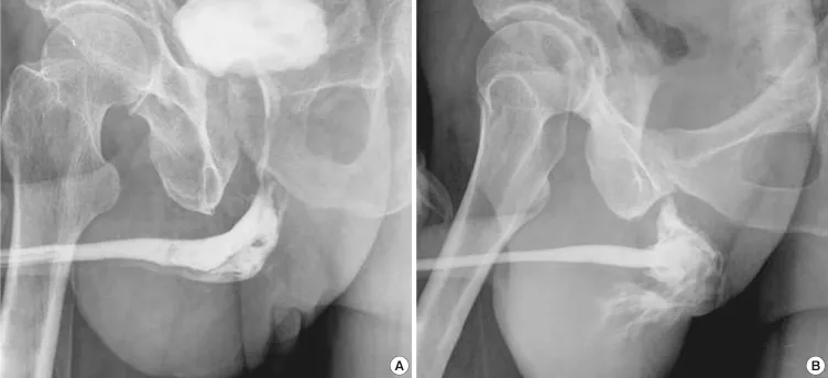 Retrograde urethrogram showing contrast extravasation