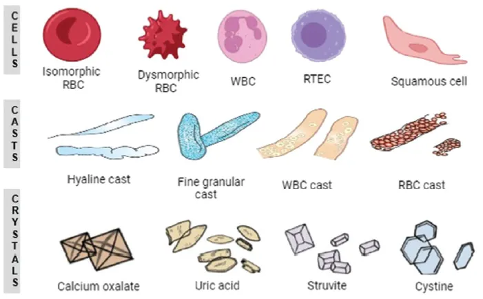 Urine Sediment: Cells, Casts, and Crystals