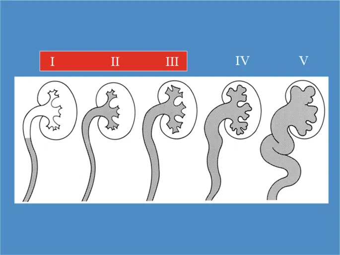 International Reflux Study Grading of VUR